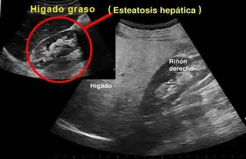Higado graso esteatosis hepatica ecografia