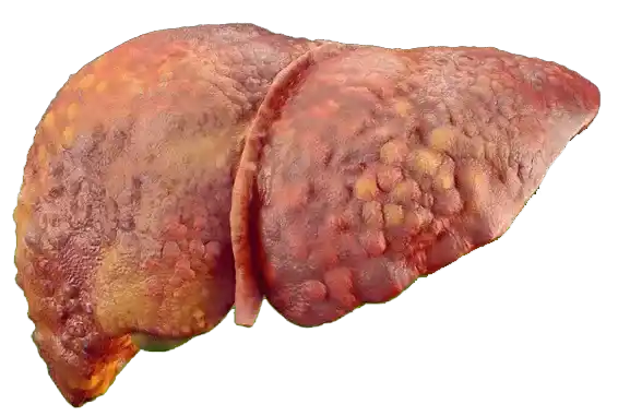esteatosis hepatica higado graso